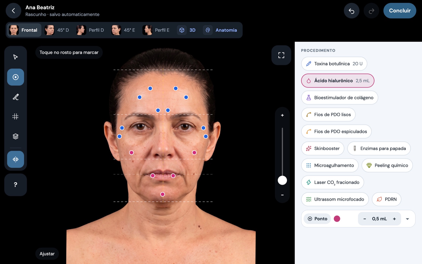 Marcações de dois procedimentos sobre a foto frontal